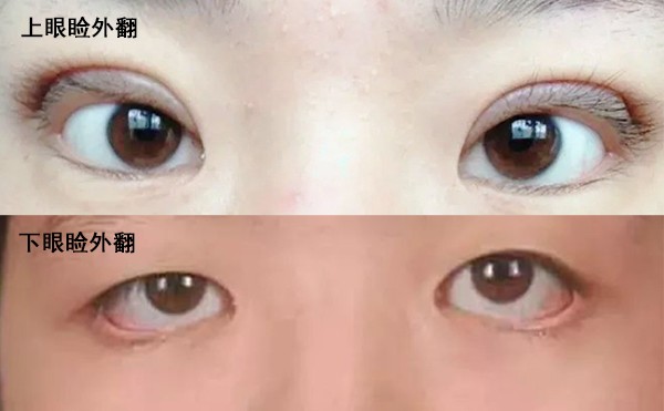 眼睑外翻是什么原因导致的？眼睑外翻怎么修复？