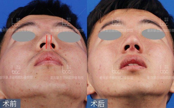 歪鼻修复术需要多少钱？修复鼻子戴鼻夹多久？