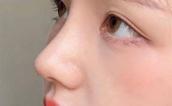 假体隆鼻取出手术难吗？假体取出来鼻子会变形吗？