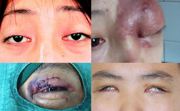 眼睑缺失可以修复吗？哪些人需要做眼睑缺失矫正？