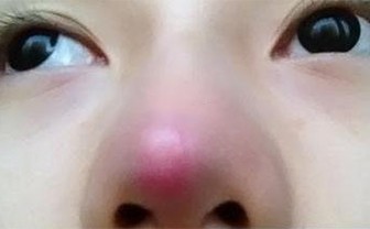 隆鼻术后鼻头发红是怎么回事？隆鼻手术失败后多久可以重新做？