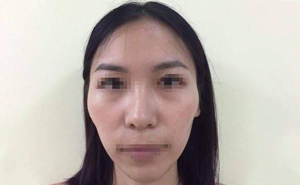 颧骨降低手术疼不疼？术后要注意什么？
