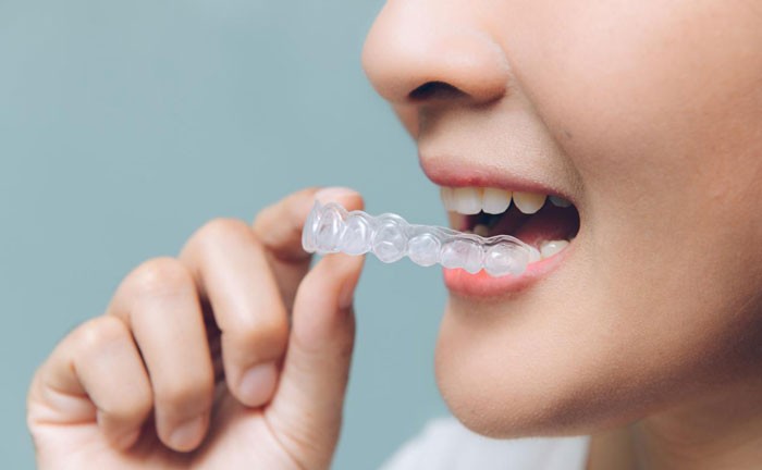 隐形牙套效果好吗？隐形牙套费用大概多少？