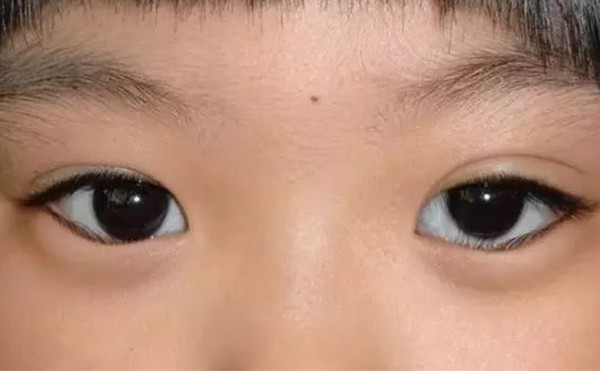 眼睑内翻是怎么回事？眼睑内翻怎么办?