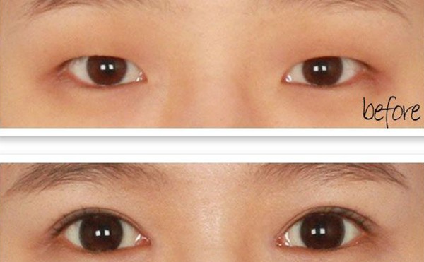 双眼皮只开眼角可以吗？单眼皮开眼角效果怎么样？