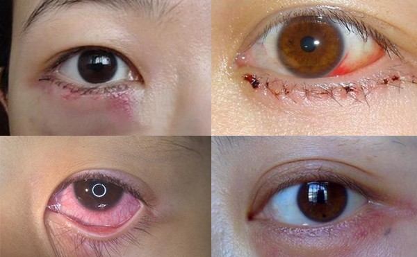 去眼袋术后出现眼睑外翻是什么原因？去眼袋术后出现眼睑外翻怎么修复？