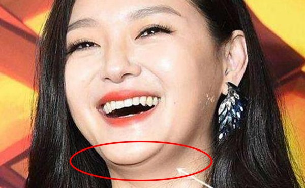 在上海韩啸双下巴吸脂多少钱？有什么优势吗？