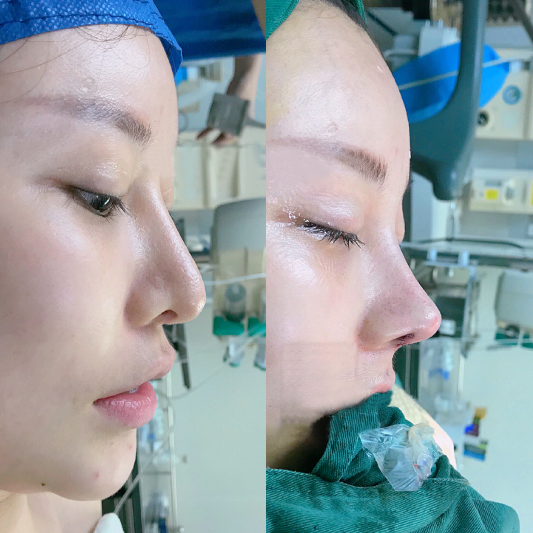隆鼻失败的原因是什么？隆鼻修复多久开始消肿？