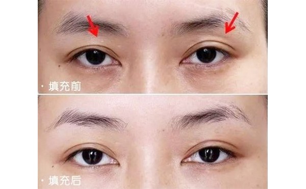 眼睑凹陷矫正过程是什么？上眼睑凹陷可以用什么方法改善？