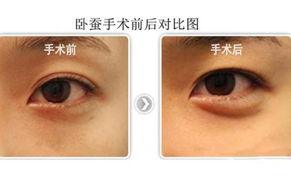 玻尿酸丰卧蚕好吗？卧蚕的后遗症有哪些？