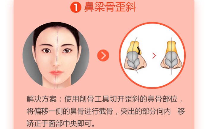 歪鼻矫正手术大概多少钱？歪鼻矫正手术成功率为多少？