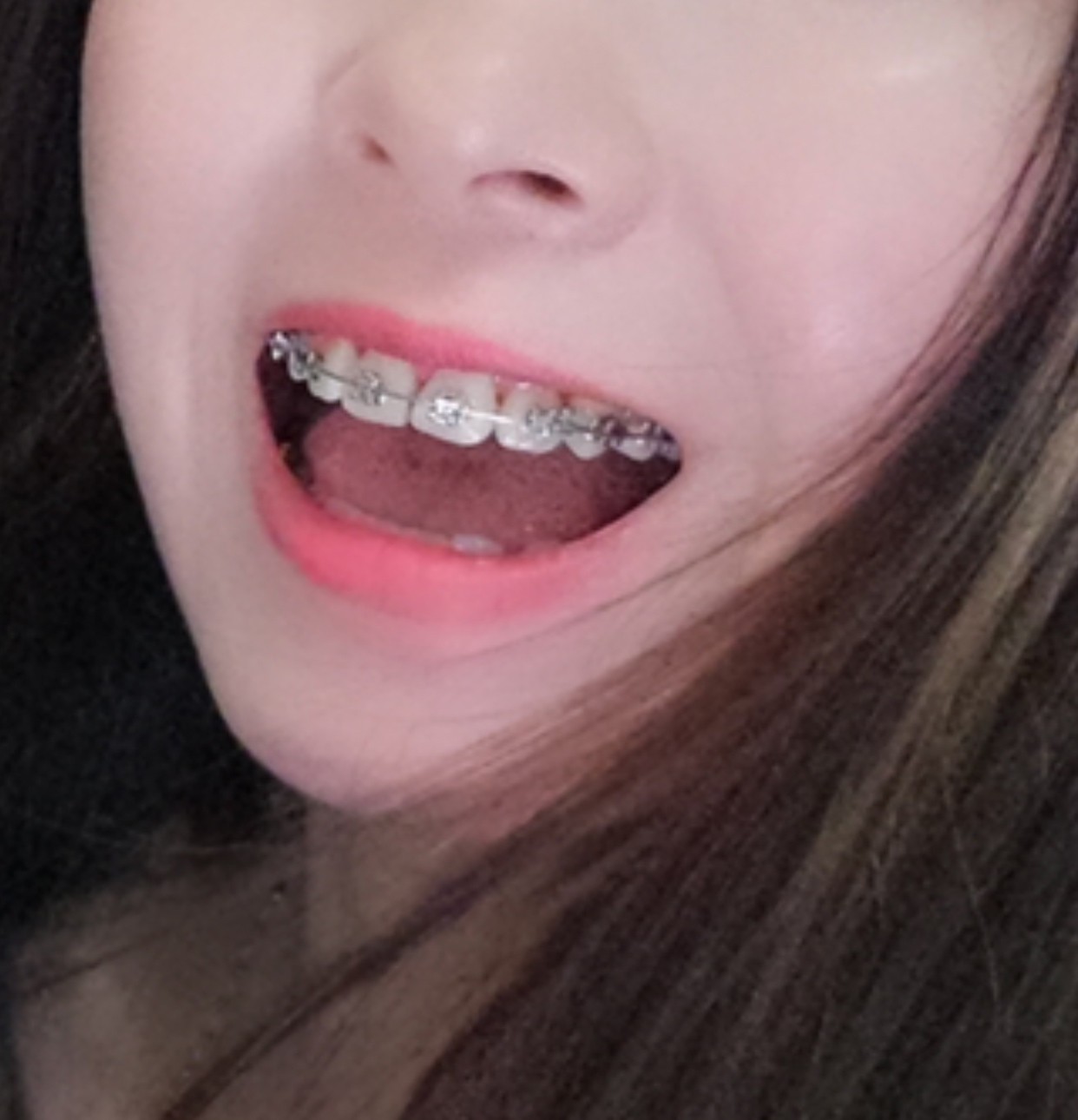 黑三角牙齿怎么修复？牙齿黑三角有什么危害吗？