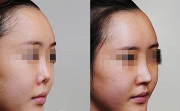 鼻翼缺损修复后和常人一样吗？鼻翼缺损修复需要多少钱？