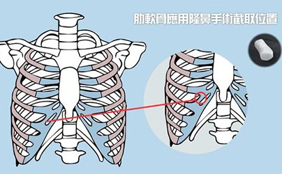 自体软骨隆鼻要多少钱？自体软骨隆鼻后遗症有哪些？