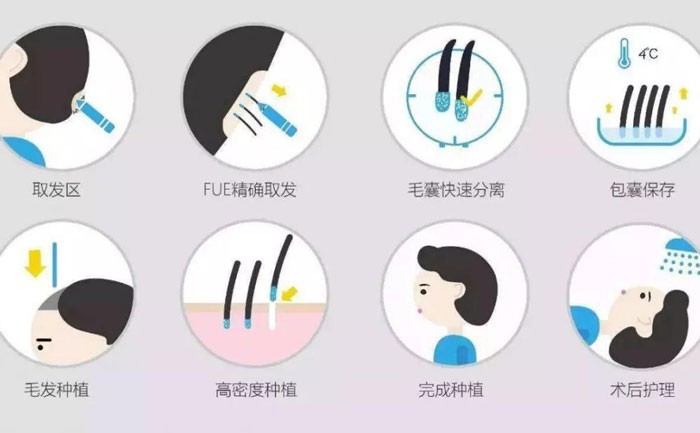 体毛种植的方法有哪些？体毛种植成活率是多少？