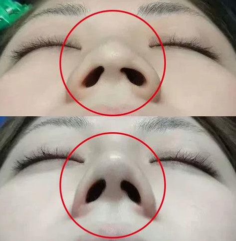 鼻头缩小手术安全吗?鼻头缩小手术费用多少钱？