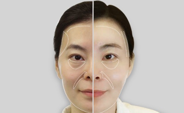 去眼袋后下眼睑为什么凹陷？去眼袋后下眼睑凹陷怎么办？