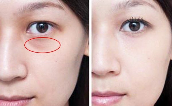 眼部泪沟是怎么形成的？泪沟填充能维持几年？