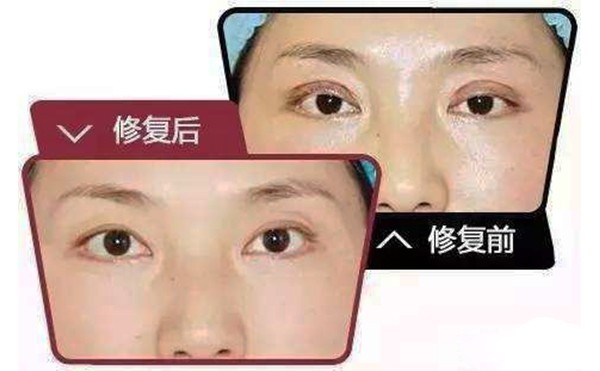 双眼皮什么情况下需要修复 ？双眼皮修复难度大吗？