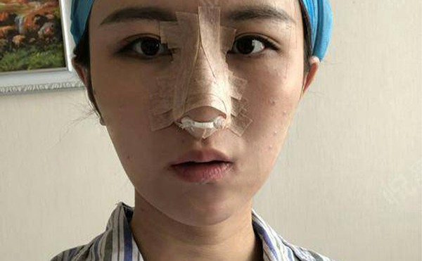 隆鼻怎么检查失败？隆鼻失败多久可以重新做？