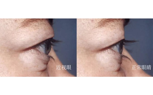 眼球突出矫正术安全吗？眼球突出矫正术后会复发吗？