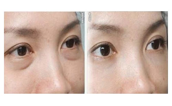 吸脂去眼袋有什么优势？吸脂去眼袋术后会复发吗？