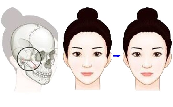 颧骨降低术是如何操作的？手术有什么特点？