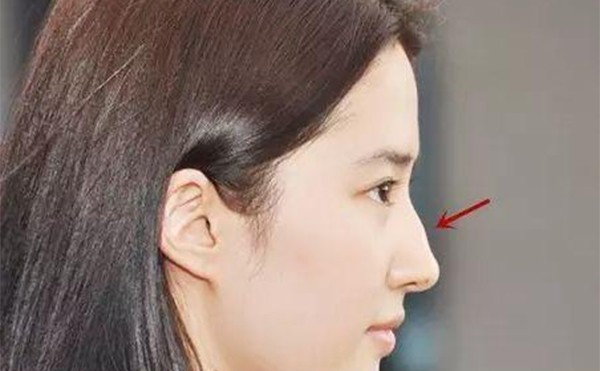 如何改善驼峰鼻？驼峰鼻手术一般多少钱？