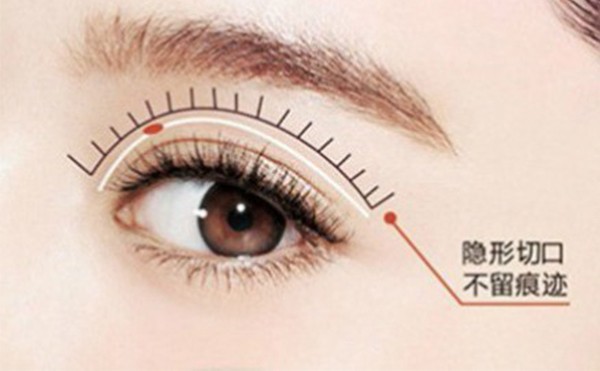微创双眼皮怎么做出来的？双眼皮消肿需要多久？