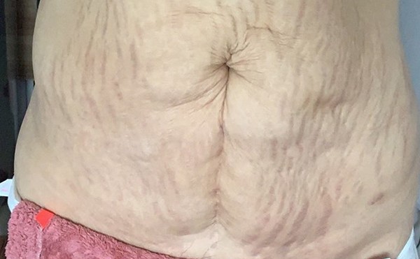 腹壁松弛有哪几种类型？腹壁成形术适合哪些人做？