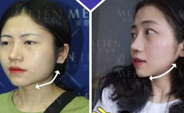 下颌角整形术可能会出现什么风险？风险多吗？