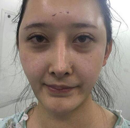 深圳阳光全脸填充术前术后对比，说年轻十岁不过分吧