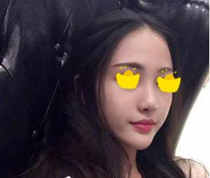 塌鼻子小妹在深圳鹏爱做隆鼻手术，三个月后竟然是这样的