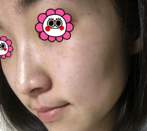 温州韩美整形激光祛斑案例治疗后三天效果