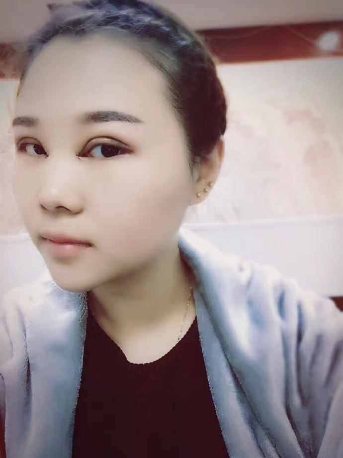 肿眼泡应该做哪种双眼皮？汕头曙光双眼皮三个月效果分享