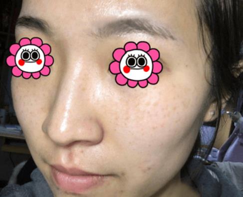 温州韩美整形激光祛斑案例治疗中效果