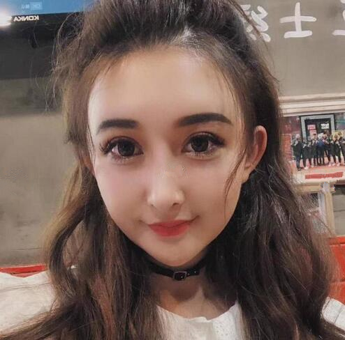 深圳阳光全脸填充术前术后对比，说年轻十岁不过分吧