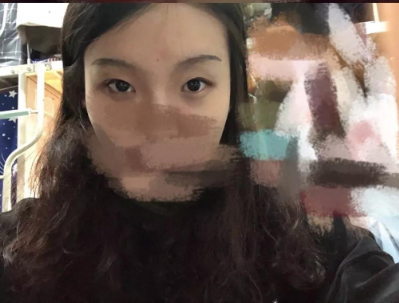 做双眼皮案例，北京艺星张顺庆双眼皮案例图片