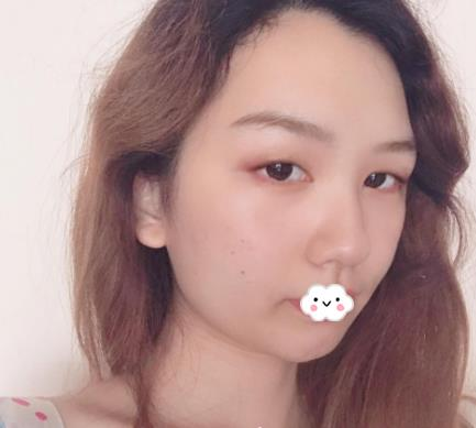 武汉伊莱美割双眼皮怎么样？切开双眼皮恢复过程图