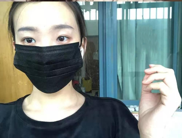 做双眼皮案例，北京艺星张顺庆双眼皮案例图片
