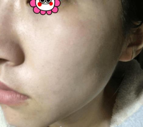温州韩美整形激光祛斑案例治疗后一个月效果