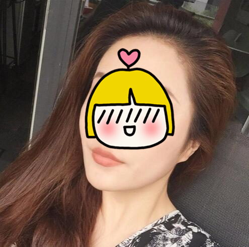 南京艺星整形赵海波面部吸脂术后一个月