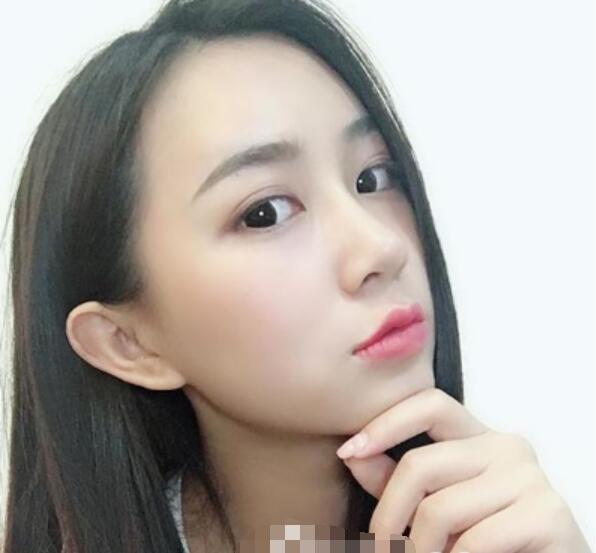 深圳鹏程整形刘冰做的鼻子术后两个月