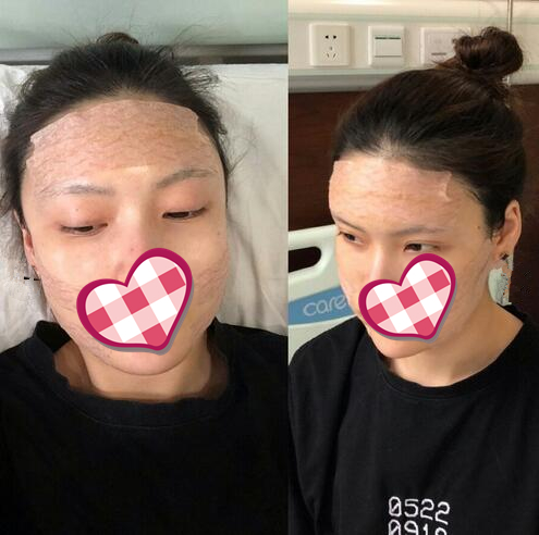 哈尔滨成美自体脂肪全脸填充案例术后第二天