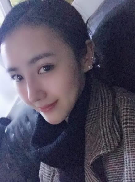 北京艺美整形鼻综合案例术后两个月