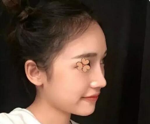 深圳福华整形陈贞宜超体隆鼻术后一个月