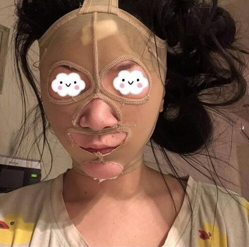南京艺星整形赵海波面部吸脂术后一周
