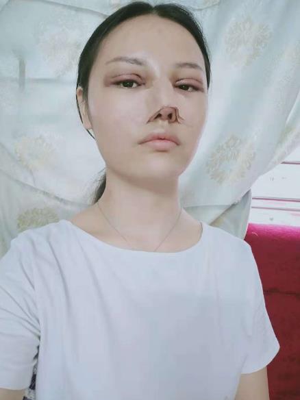 长沙雅美眼鼻整形案例术后第二天效果