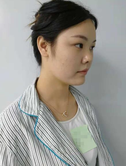 长沙雅美眼鼻整形案例术前效果