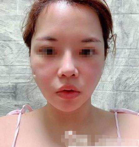 南京阅颜整形瘦脸针注射后八天